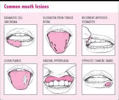 Mouth Ulcer ~ The Official Blog of Grannytherapy