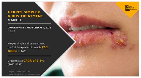 Herpes Simplex Virus Treatment Market Statistics and Forecast - 2031