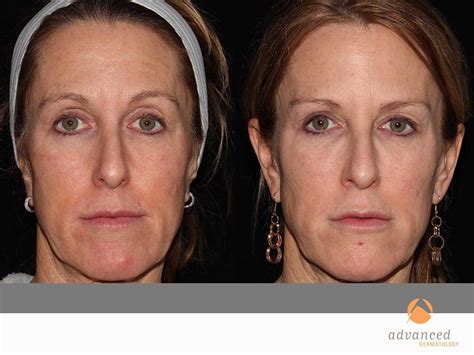 Liquid Facelift | Advanced Dermatology