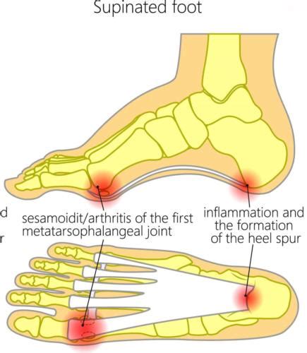 Bone Spurs Big Toe: AKA Stiff Big Toe or Hallux Rigidus [Best Treatment]