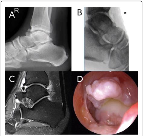 Anterior ankle impingement. (A) a pre-operative lateral radiograph of a... | Download Scientific ...