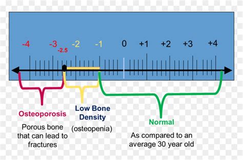 Understanding Bone Density Results - Scale Of Osteoporosis, HD Png Download - 820x491(#1808072 ...