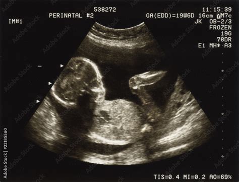 Ultrasound of a fetus at 20 weeks Stock Photo | Adobe Stock