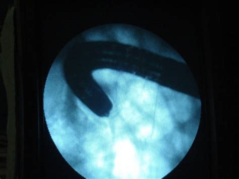 Ileoscopy; How and Why to Do It | IntechOpen