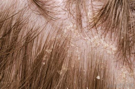 Home Remedies for Severe Dandruff | Healthy Central Blog