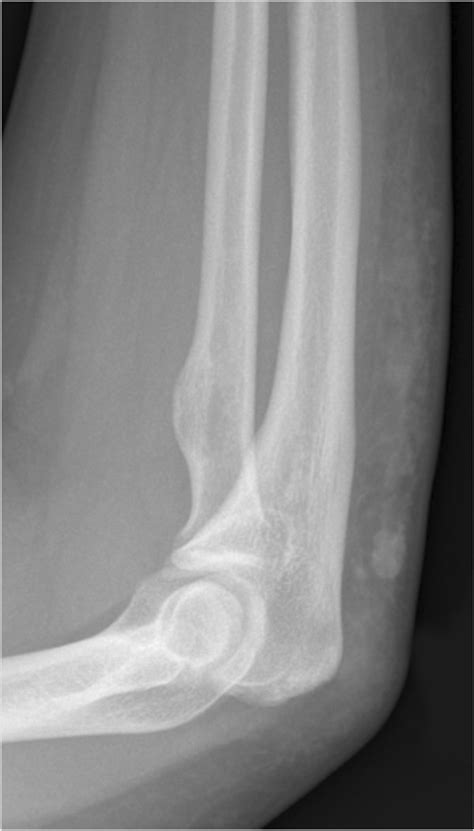 X-ray imaging of gouty tophus in an adolescent. Lateral view of the ...