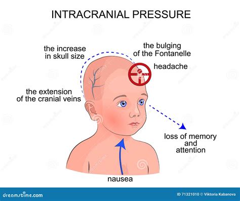 The Symptoms of Intracranial Pressure in Children Stock Vector - Illustration of occipital ...