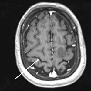 Central sulcus – Radiology Cases