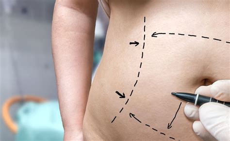 15 Things You Can Do To Get A Tummy Tuck Naturally - Viral Rang