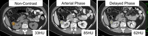 Kidney Cancer Diagnosis | Johns Hopkins Medicine