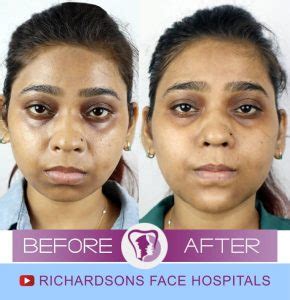 4 Things You Must Know About Chin Augmentation Surgery in India – Richardson's Plastic Surgery ...