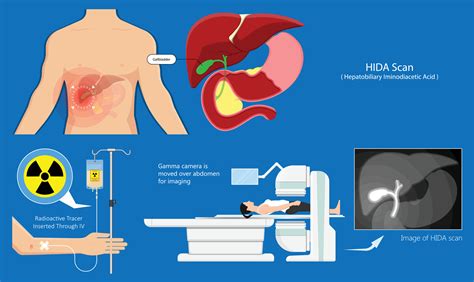 HIDA Scan: Procedure, Results and Cost - Apollo Hospital Blog