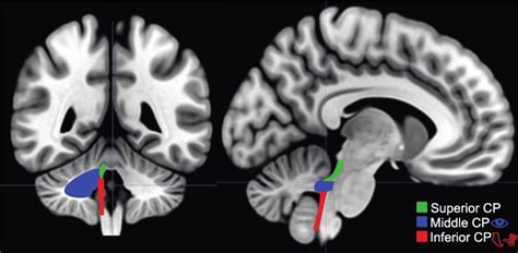 Cerebellar Peduncle Anatomy