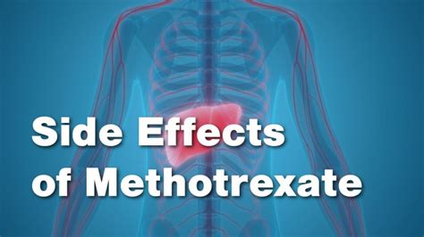 Side Effects of Methotrexate • Johns Hopkins Rheumatology