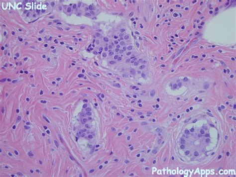 carcinoid appendix histology