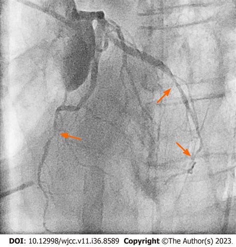 Intraoperative cardiogenic shock induced by refractory coronary artery spasm in a patient with ...