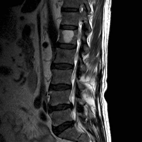 Vertebral haemangioma | Radiology Reference Article | Radiopaedia.org | Radiology, Radiology ...