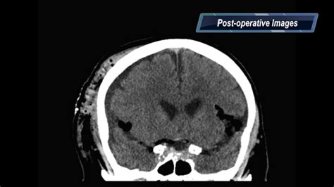 Surgical Neurology International