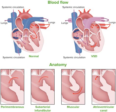 Comunicação Interventricular | Concise Medical Knowledge