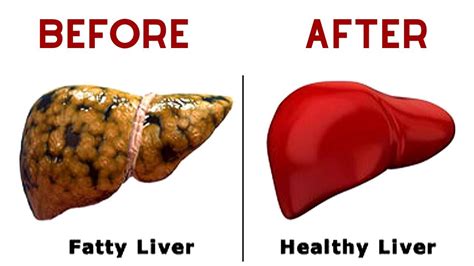 Reverse fatty liver disease and lose weight with this 3 day treatment ...