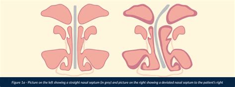 Deviated nasal septum (Bent or crooked nasal septum) - Dr Gan Eng Cern