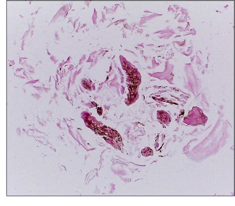 Figure 1 from Facial Eruptive Vellus Hair Cysts Occurred after 3% Minoxidil Application ...