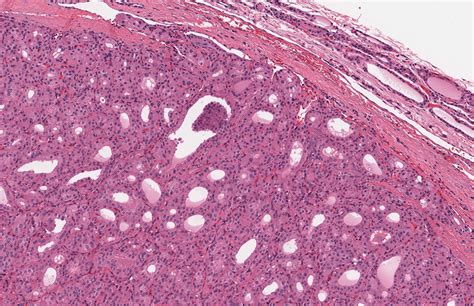 Pathology Outlines - Oncocytic (Hürthle cell) tumors