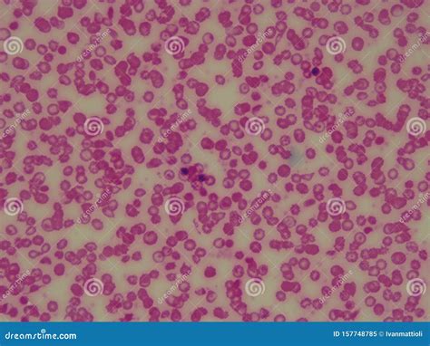 Sickle Cell Anemic Blood Under Microscope. Red Blood Cells Stock Image - Image of human, test ...