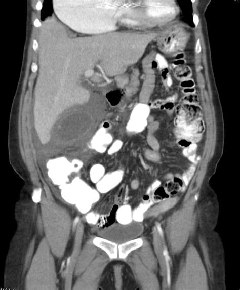 Acute Cholecystitis - Liver Case Studies - CTisus CT Scanning