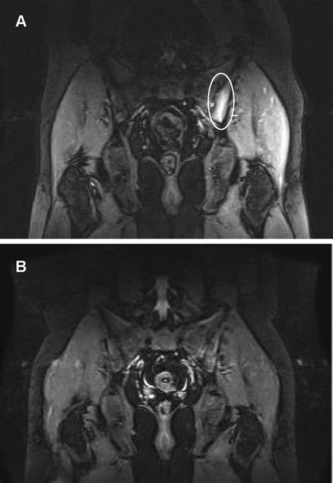 Sacroiliac Joint Dysfunction Mri