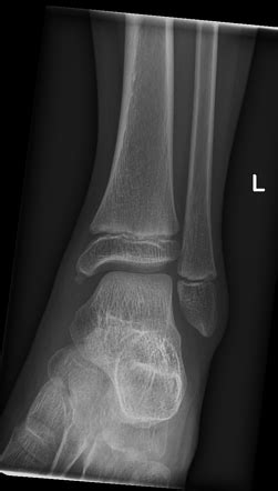 Ankle series (pediatric) | Radiology Reference Article | Radiopaedia.org