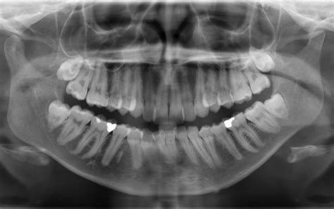 Radiographic Interpretation: Getting the Most out of Dental Radiographs. | Dental ED