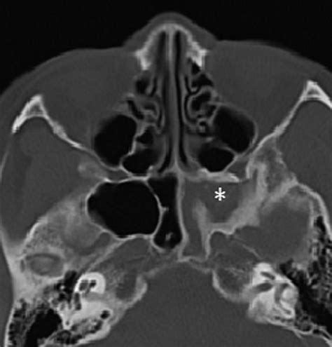 Sphenoid Sinus