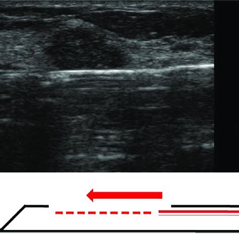 (PDF) Serial image changes in ultrasonography after the excision of ...