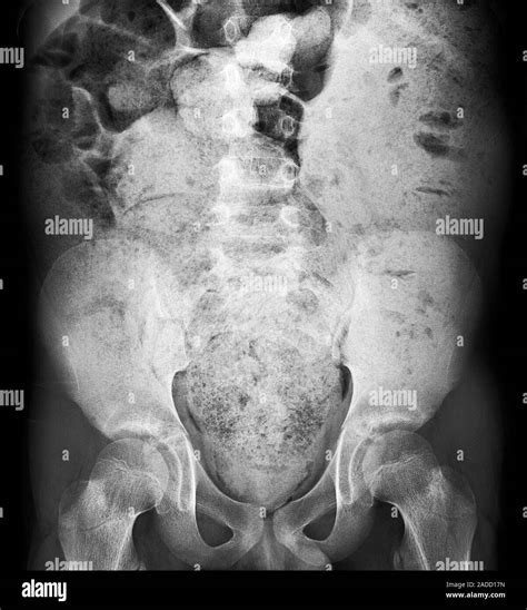 Bowel obstruction, X-ray. The image shows dilatation of the large bowel and massive faecal ...