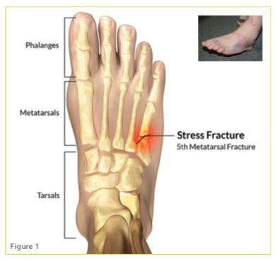 Jones Fracture - Sports Clinic NQ