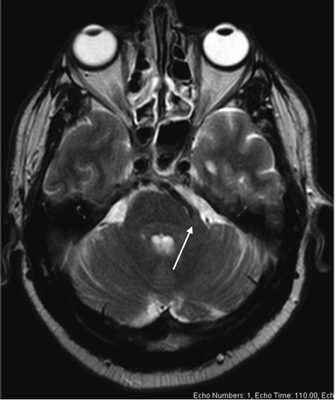 Dolichoectasia at the left vertebral artery on axial T2 weighted image... | Download Scientific ...