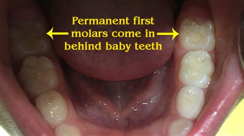 [DIAGRAM] Diagram Of Mouth Right Behind Rear Molar - MYDIAGRAM.ONLINE