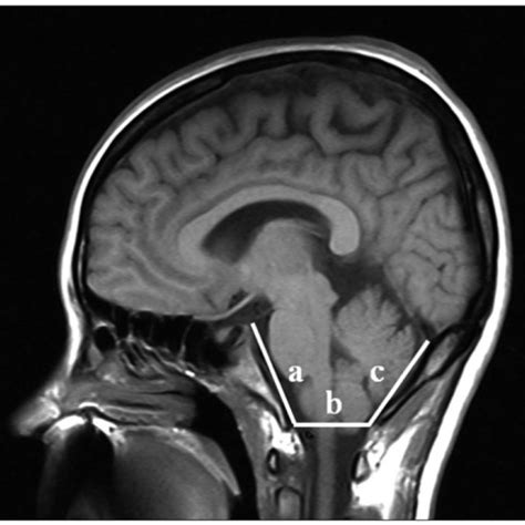 Midsagittal T1-weighted MRI shows the posterior cranial fossa, the... | Download Scientific Diagram