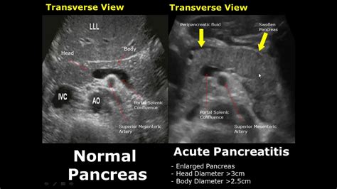 Pancreas Ultrasound Normal Vs Abnormal Image Appearances Comparison | Pancreatic Pathologies USG ...