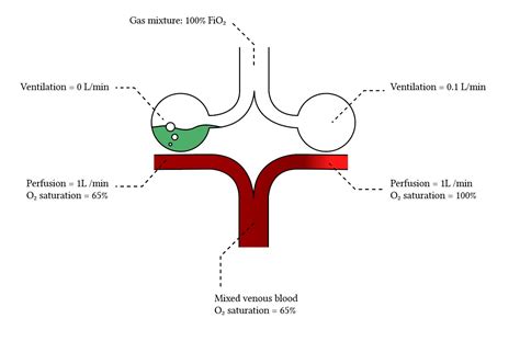 Effects of ventilation-perfusion mismatch on gas exchange | Deranged ...