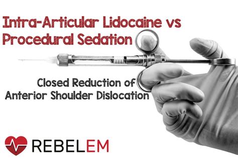 Intra-articular Lidocaine vs Procedural Sedation and Analgesia for Closed Reduction of Acute ...