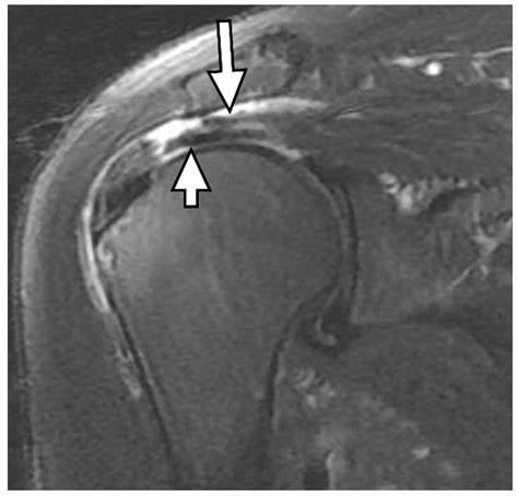 Supraspinatus Tear