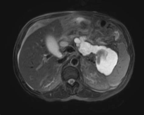 Pancreatic pseudocyst CT - wikidoc