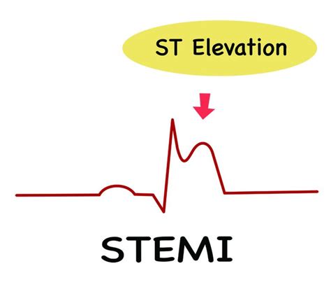 ST-Elevation Acute Myocardial Infarction Treated with Primary ...