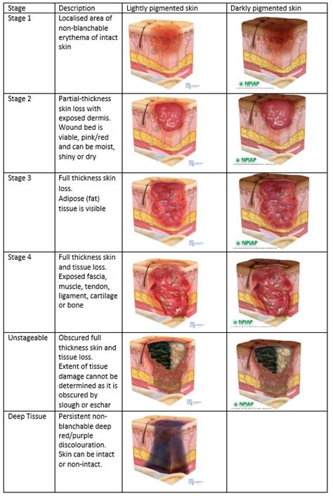 Pressure Ulcer Staging Guide