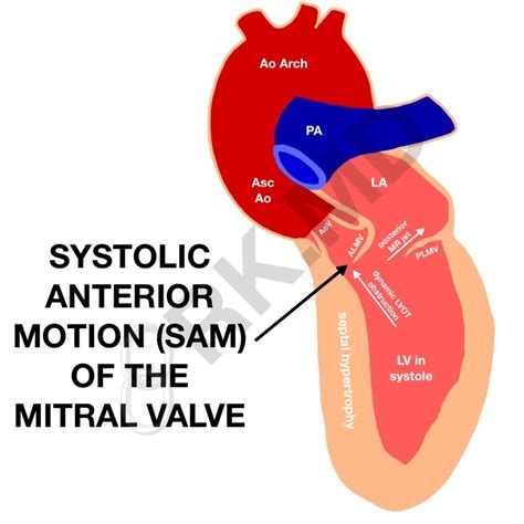 Systolic Anterior Motion (SAM) Of The Mitral Valve - Left Ventricular Outflow Tract (LVOT ...