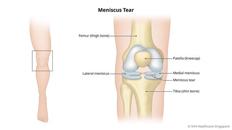 Meniscus Tear (Knee Injury) - Symptoms & Causes | Parkway Shenton