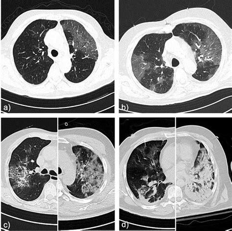 Examples of CT patterns: a) normal pulmonary parenchyma (Severity Score ...