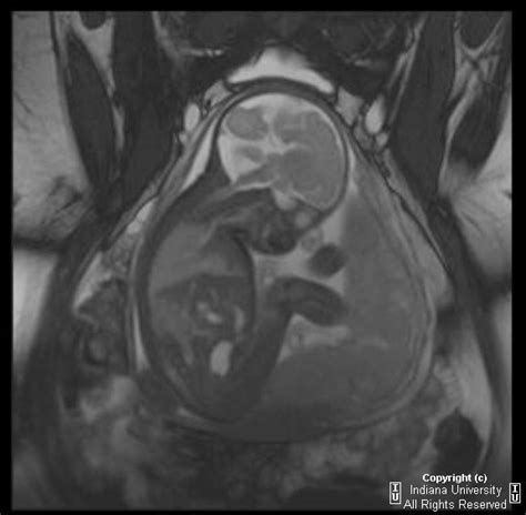 Neuroradiology On the Net: Dandy Walker malformation